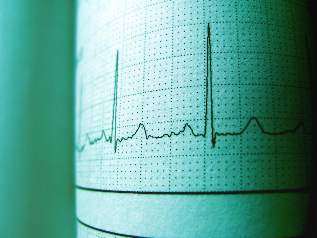 ecg